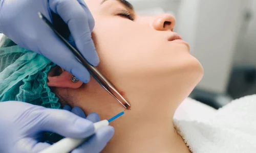 zabiegi-kosmetyczne-elektrokoagualacja